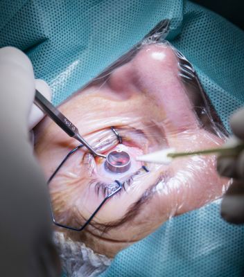 cataract surgery (mics & flacs) bloom vision clinic
