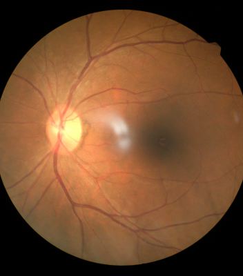 diabetic retinopathy screening & treatment bloom vision clinic